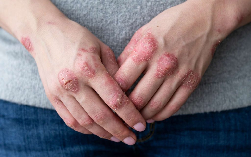 psoriasis contagieux psoriasis contagieux